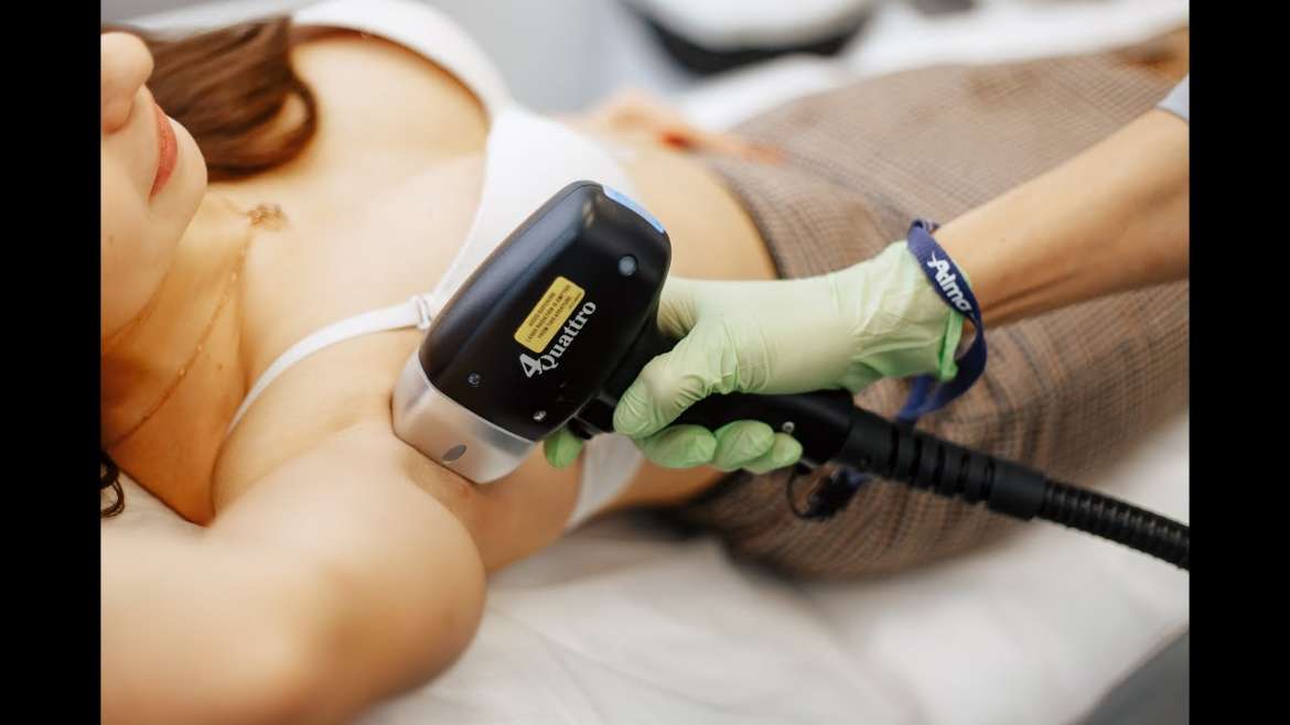 Diode laser hair removal