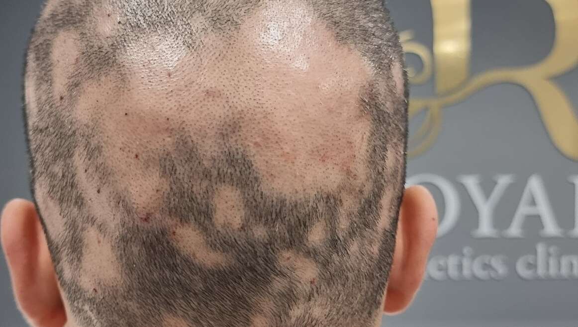 Alopecia areata and its treatment | The newest Technologies | Wonderful results